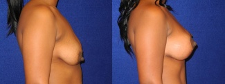 Right Profile View - Breast Augmentation with Lift - Silicone Implants