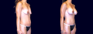 Right 3/4 View - Breast Augmentation with Lift and Tummy Tuck After Pregnancy