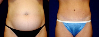 Frontal View - Tummy Tuck and Hip Liposuction