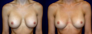 Frontal View - Breast Implant Revision - Silicone Implants