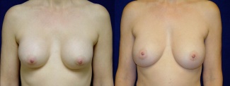 Frontal View - Breast Implant Revision - Silicone Implants
