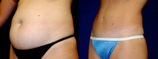 Left 3/4 View - Tummy Tuck and Hip Liposuction