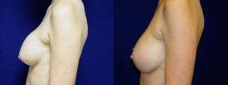 Left Profile View - Breast Implant Revision - Silicone Implants