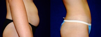 Right Profile View - Tummy Tuck and Hip Liposuction
