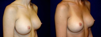 Right 3/4 View - Breast Implant Revision - Silicone Implants