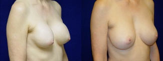 Right 3/4 View - Breast Implant Revision - Silicone Implants