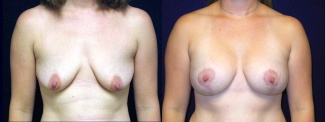 Frontal View - Breast Augmentation After Pregnancy