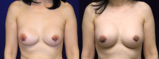 Frontal View - Breast Implant Revision