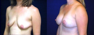 Left 3/4 View - Breast Augmentation After Pregnancy