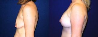 Left Profile View - Breast Augmentation After Pregnancy