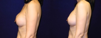 Left Profile View - Breast Implant Revision