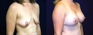 Right 3/4 View - Breast Augmentation After Pregnancy