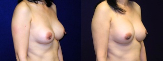 Right 3/4 View - Breast Implant Revision