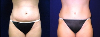 Frontal View - Tummy Tuck After Pregnancy
