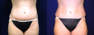 Frontal View - Tummy Tuck After Pregnancy