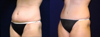 Left 3/4 View - Tummy Tuck After Pregnancy