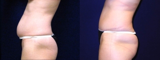 Left Profile View - Tummy Tuck After Pregnancy
