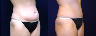 Right 3/4 View - Tummy Tuck After Pregnancy