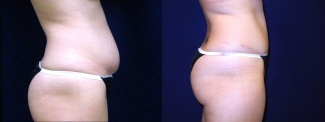 Right Profile View - Tummy Tuck After Pregnancy