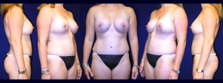 Full View - Breast Augmentation and Tummy Tuck 