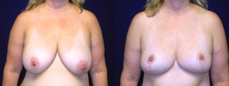 Frontal View - Breast Reduction Mastopexy After Pregnancy