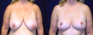 Frontal View - Breast Reduction Mastopexy After Pregnancy