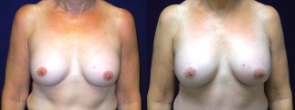 Frontal View - Breast Implant Revision - Silicone Implants