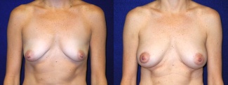 Frontal View - Breast Augmentation with Silicone Implants and Periareolar Mastopexy