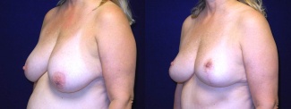 Left 3/4 View - Breast Reduction Mastopexy After Pregnancy