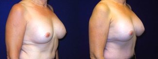 Right 3/4 View - Breast Implant Revision - Silicone Implants