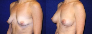 Left 3/4 View - Breast Augmentation with Silicone Implants and Periareolar Mastopexy