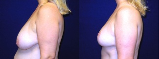 Left Profile View - Breast Reduction Mastopexy After Pregnancy