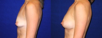 Left Profile View - Breast Augmentation with Silicone Implants and Periareolar Mastopexy