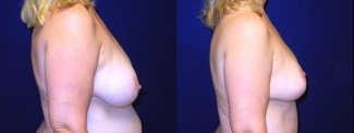 Right Profile View - Breast Reduction Mastopexy After Pregnancy