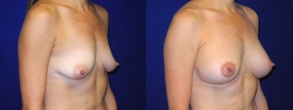 Right 3/4 View - Breast Augmentation with Silicone Implants and Periareolar Mastopexy