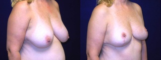 Right 3/4 View - Breast Reduction Mastopexy After Pregnancy