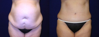 Frontal View - Tummy Tuck After Pregnancy