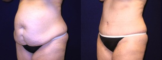 Left 3/4 View - Tummy Tuck After Pregnancy