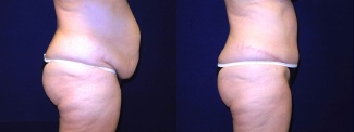 Right Profile View - Tummy Tuck After Pregnancy