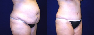 Right 3/4 View - Tummy Tuck After Pregnancy