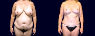 Frontal View - Breast Reduction Mastopexy and Tummy Tuck After Pregnancy