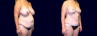 Right 3/4 View - Breast Reduction Mastopexy and Tummy Tuck After Pregnancy