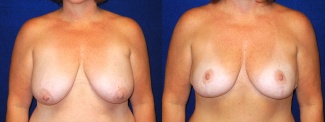 Frontal View - Breast Lift After Pregnancy