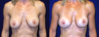 Frontal View - Breast Implant Revision - Silicone Implants