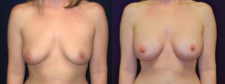 Frontal View - Breast Augmentation - Silicone Implants