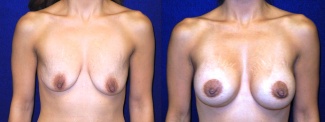 Frontal View - Breast Augmentation with Lift After Pregnancy