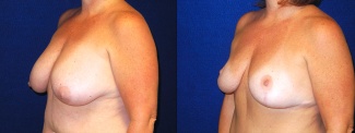 Left 3/4 View - Breast Lift After Pregnancy