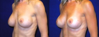 Left 3/4 View - Breast Implant Revision - Silicone Implants