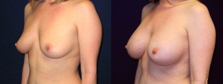 Left 3/4 View - Breast Augmentation - Silicone Implants