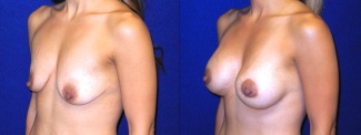 Left 3/4 View - Breast Augmentation with Lift After Pregnancy